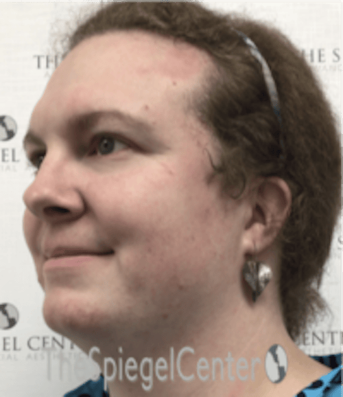 FFS Before & After Gallery - Patient 615340 - Image 3