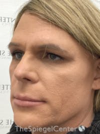 FFS Before & After Gallery - Patient 735387 - Image 1