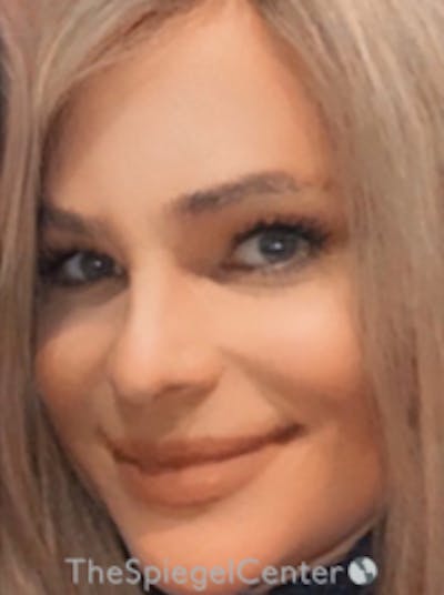 FFS Before & After Gallery - Patient 735387 - Image 2