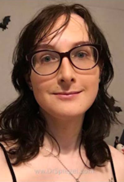 FFS Before & After Gallery - Patient 330235 - Image 2