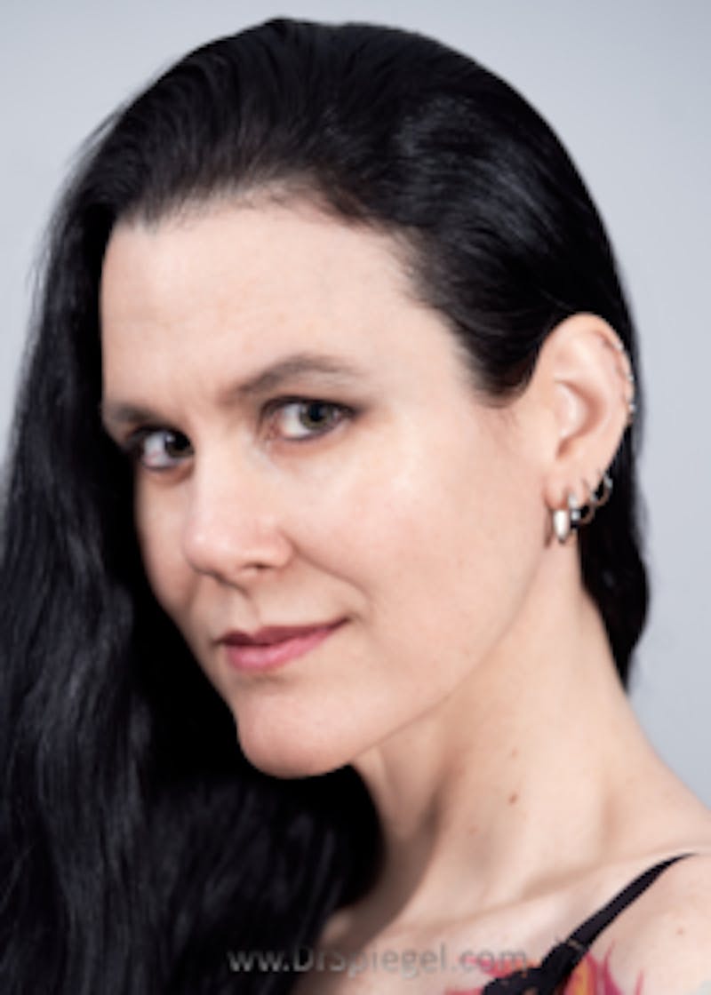 FFS Before & After Gallery - Patient 264605 - Image 2