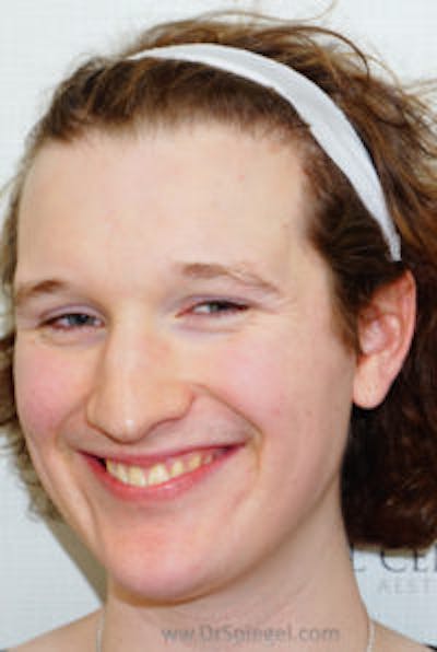 FFS Before & After Gallery - Patient 171441 - Image 1