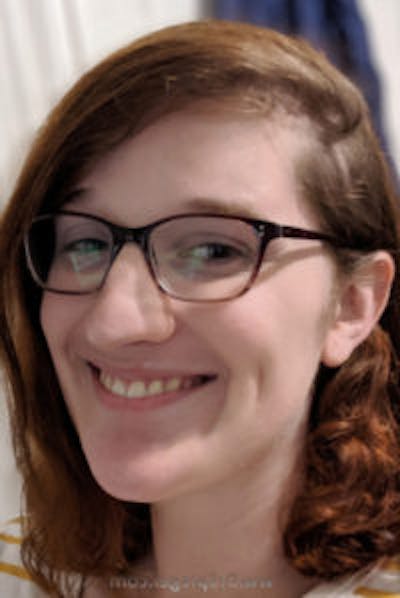 FFS Before & After Gallery - Patient 171441 - Image 2