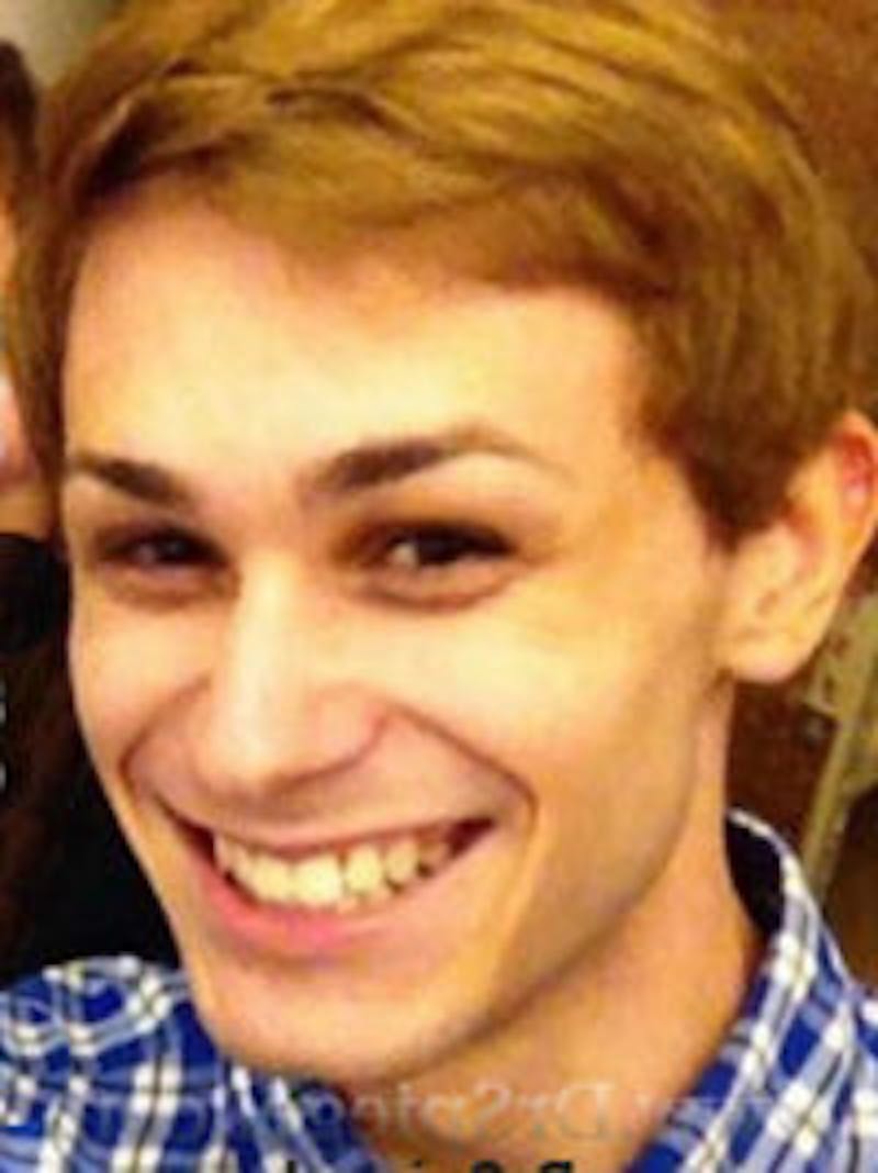 FFS Before & After Gallery - Patient 383648 - Image 1