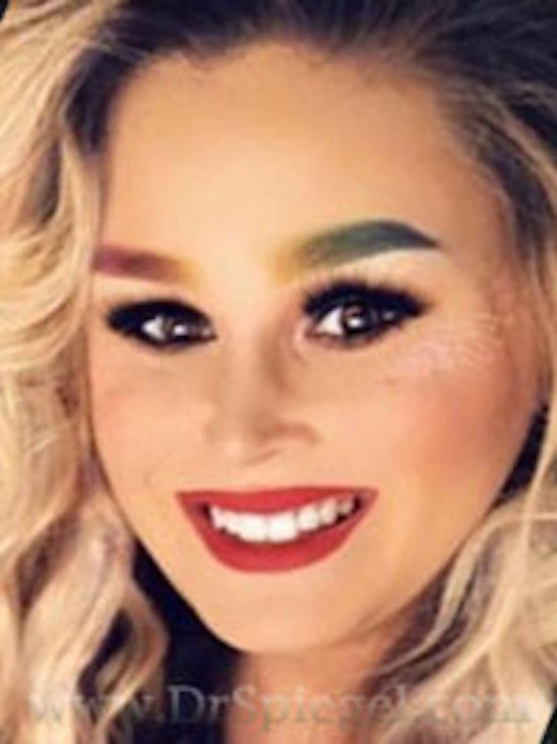 FFS Before & After Gallery - Patient 383648 - Image 2