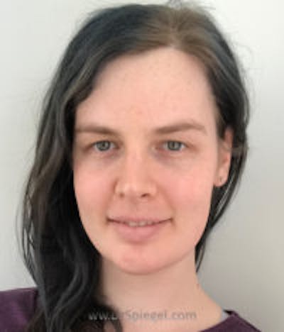 FFS Before & After Gallery - Patient 209647 - Image 2