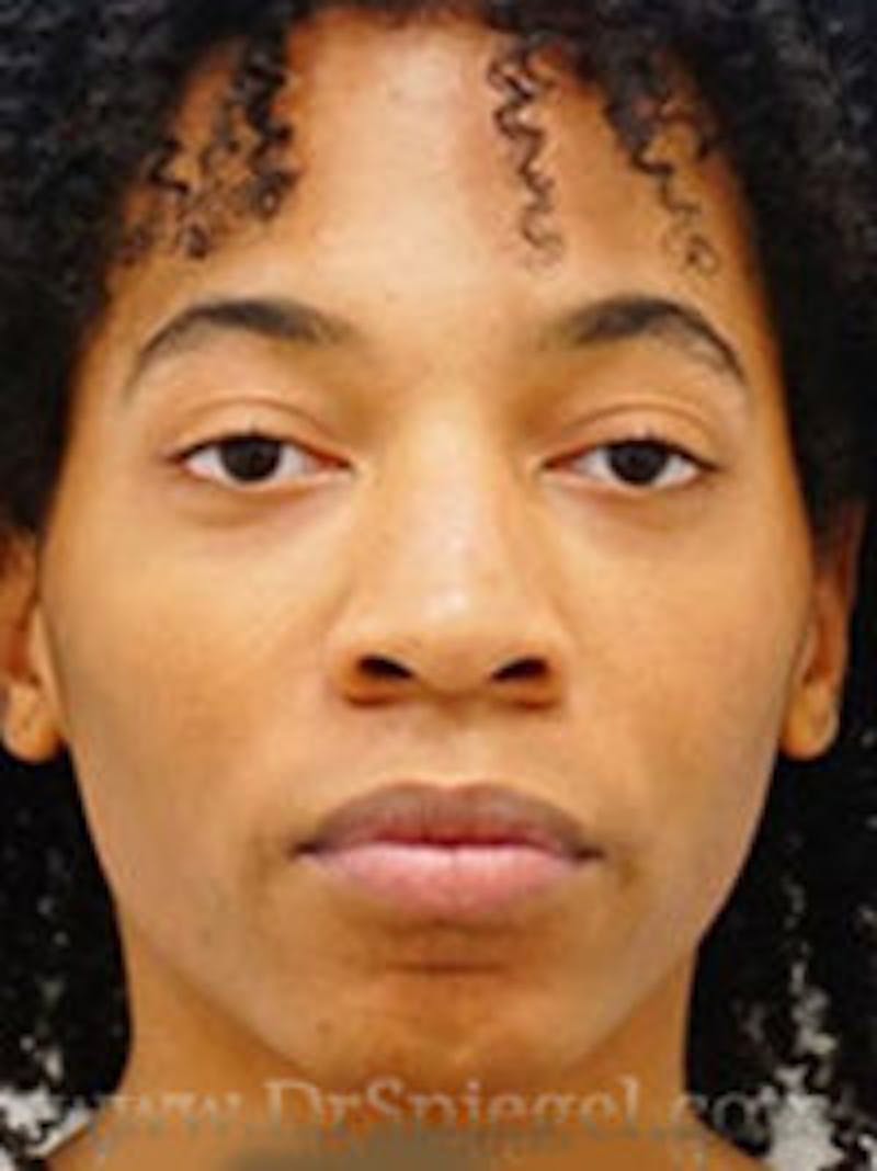 FFS Before & After Gallery - Patient 368952 - Image 1