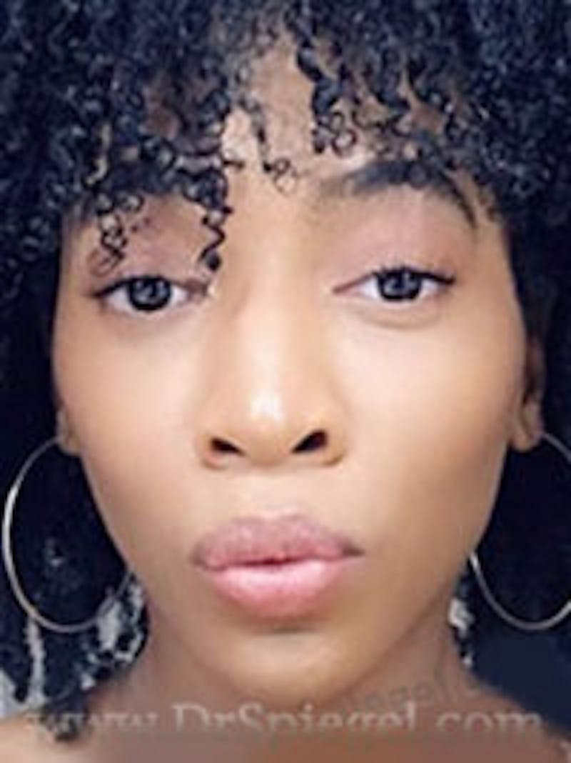 FFS Before & After Gallery - Patient 368952 - Image 2