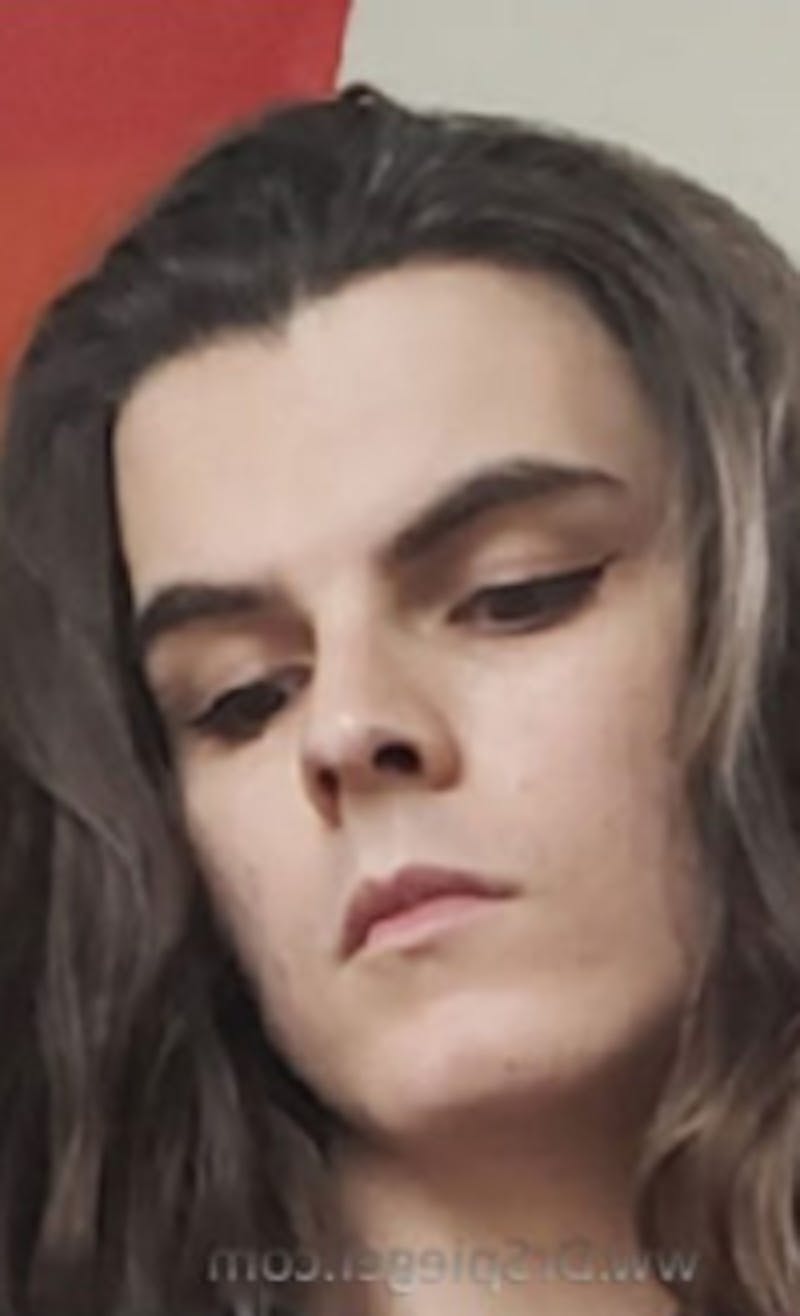 FFS Before & After Gallery - Patient 218269 - Image 1