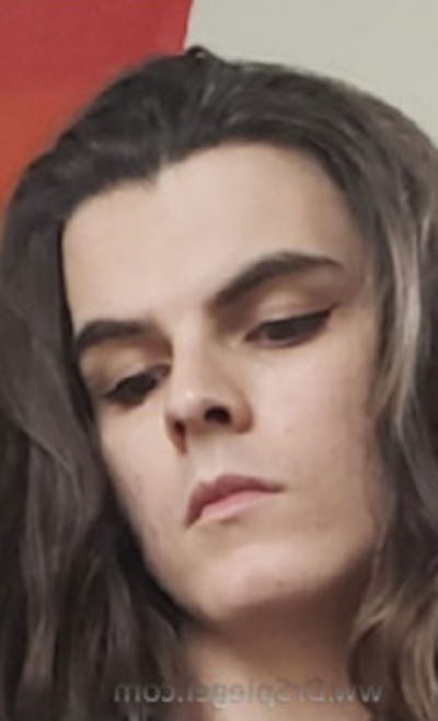 FFS Before & After Gallery - Patient 218269 - Image 1