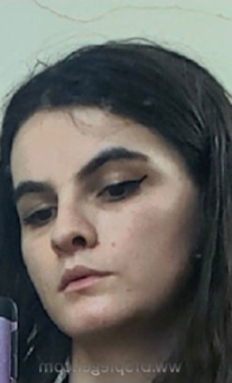 FFS Before & After Gallery - Patient 218269 - Image 2