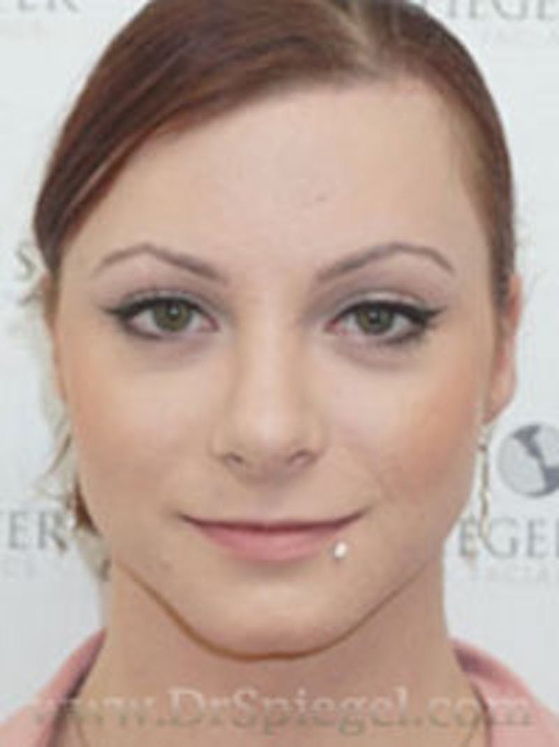 FFS Before & After Gallery - Patient 279341 - Image 2