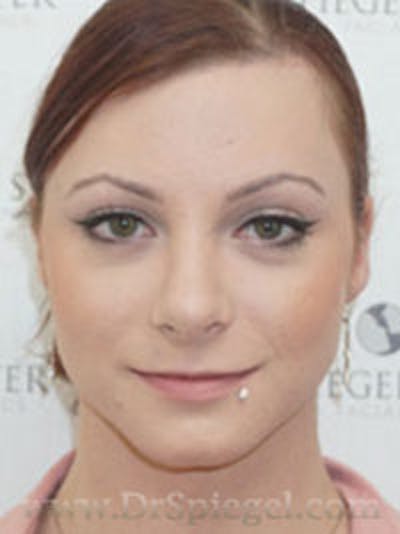 FFS Before & After Gallery - Patient 279341 - Image 2