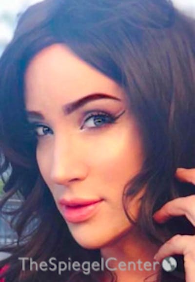 FFS Before & After Gallery - Patient 163336 - Image 2