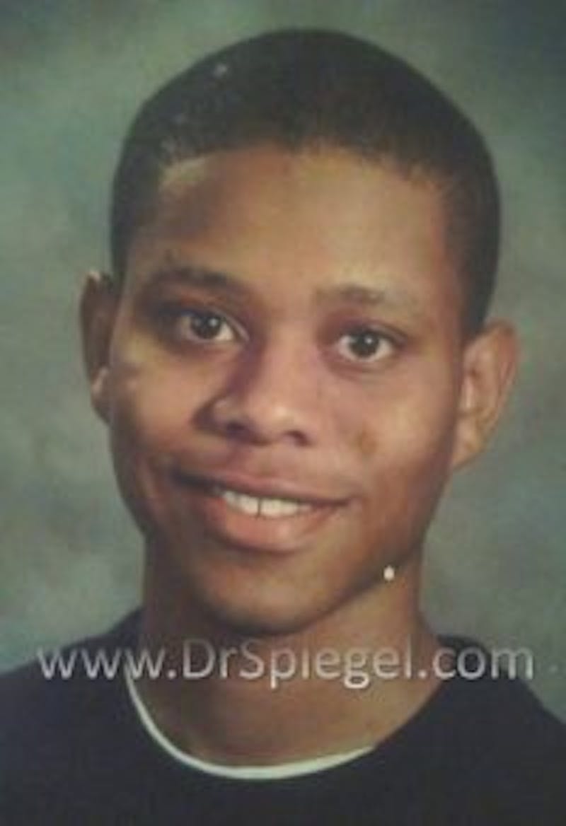 FFS Before & After Gallery - Patient 970013 - Image 1