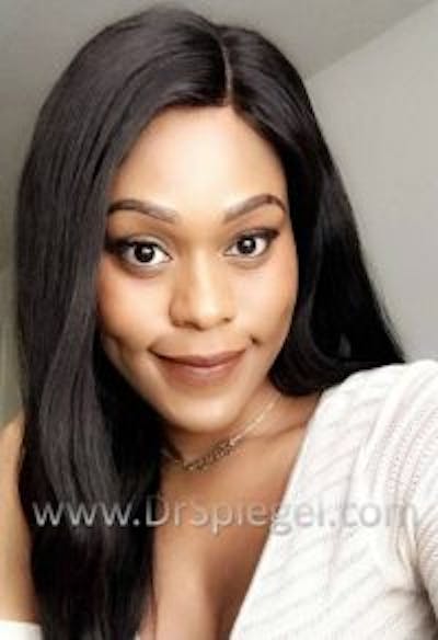 FFS Before & After Gallery - Patient 970013 - Image 2