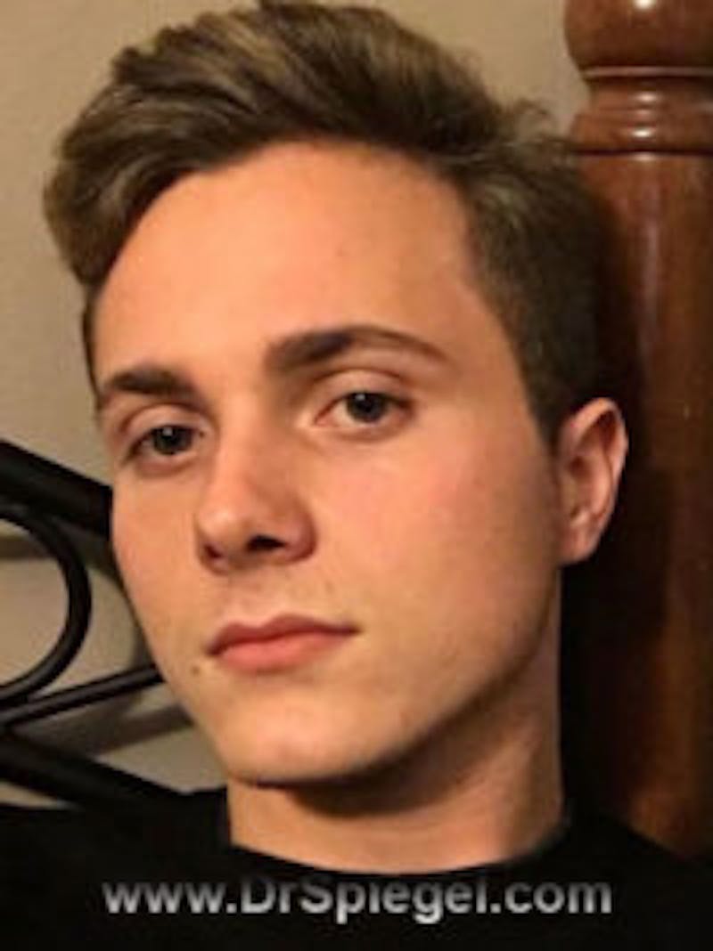 FFS Before & After Gallery - Patient 102341 - Image 1