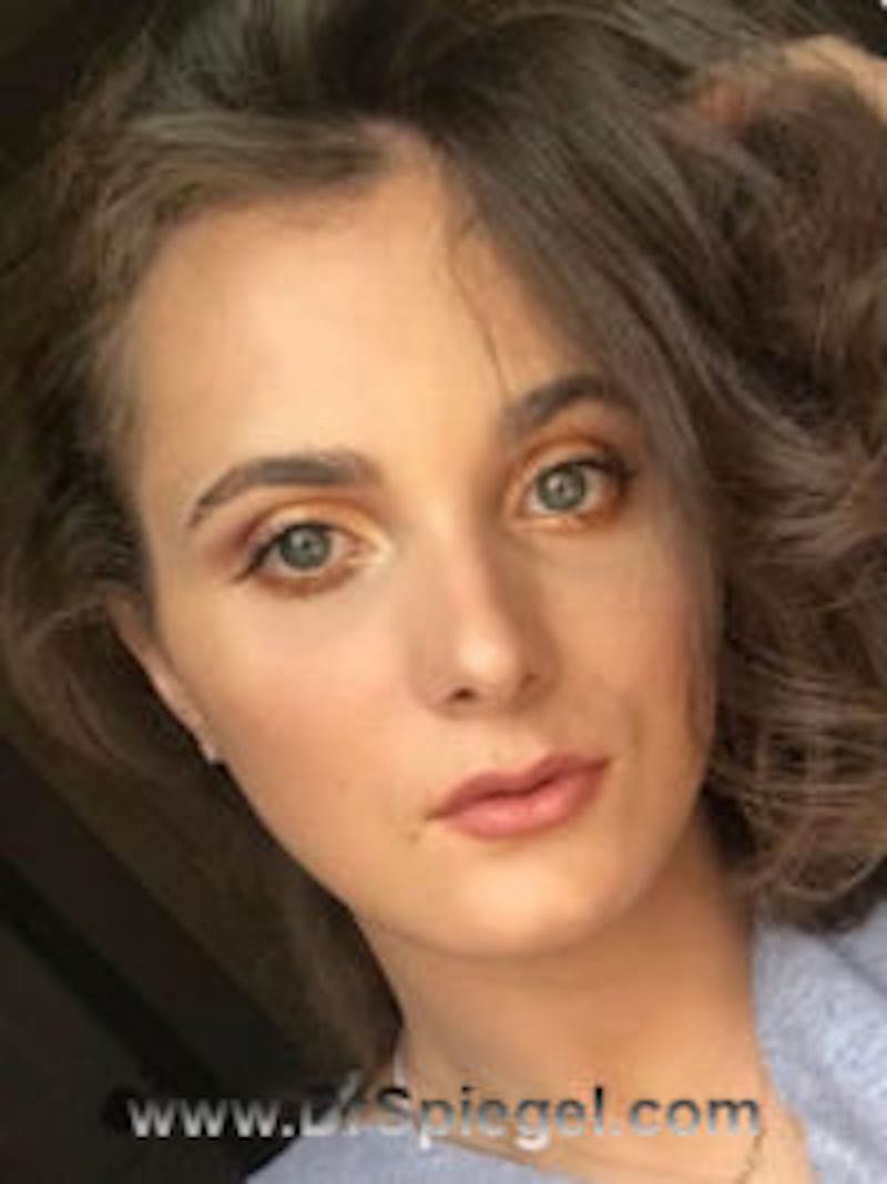 FFS Before & After Gallery - Patient 102341 - Image 2