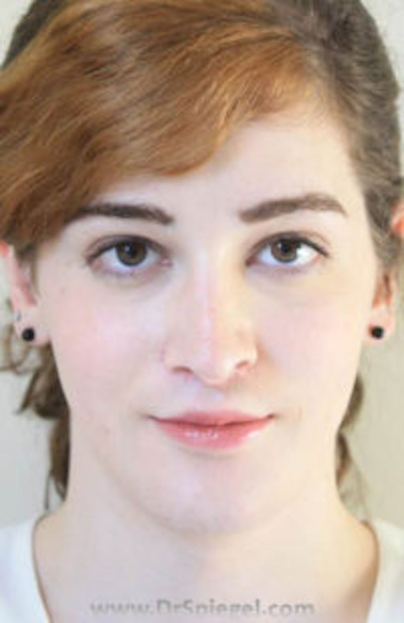 FFS Before & After Gallery - Patient 272666 - Image 2