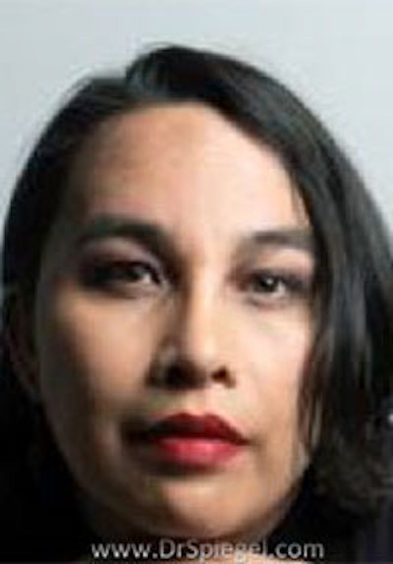 FFS Before & After Gallery - Patient 768237 - Image 2