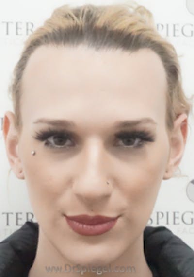 FFS Before & After Gallery - Patient 195517 - Image 1