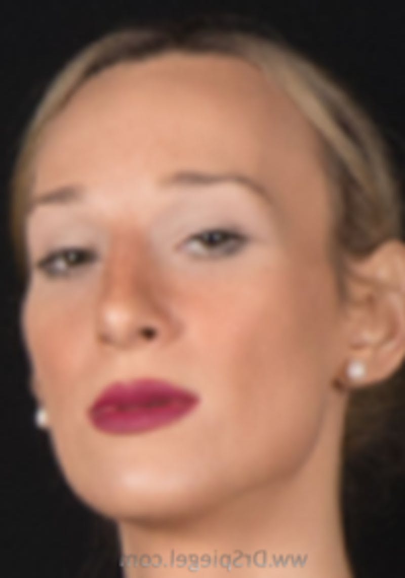 FFS Before & After Gallery - Patient 195517 - Image 2