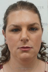 FFS Before & After Gallery - Patient 330084 - Image 1