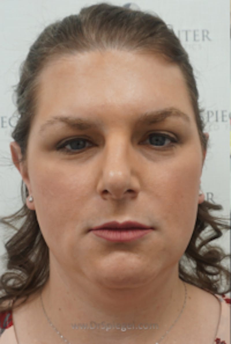 FFS Before & After Gallery - Patient 330084 - Image 1