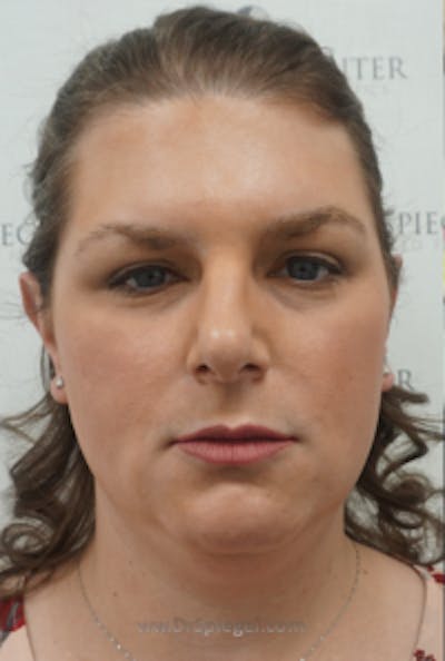 FFS Before & After Gallery - Patient 330084 - Image 1