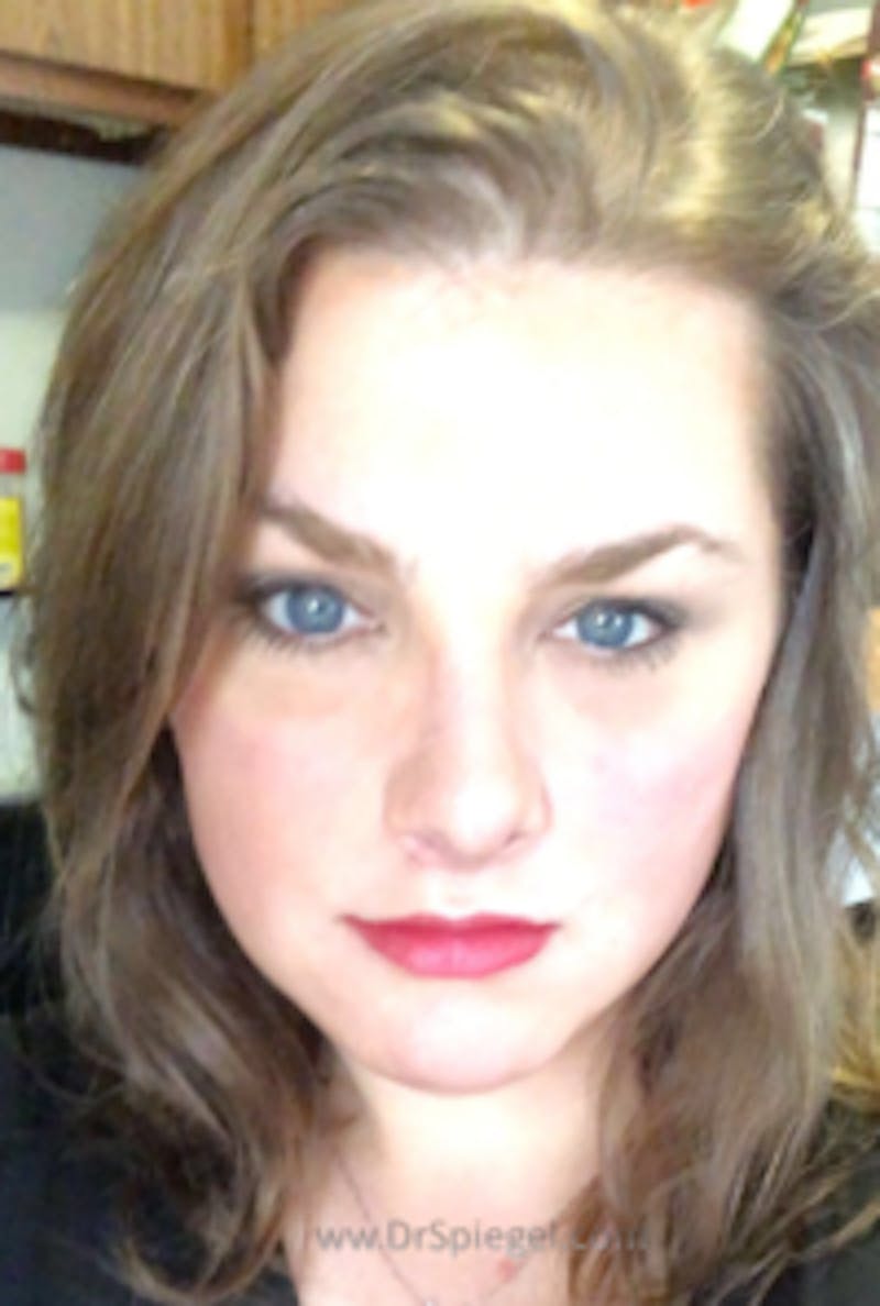 FFS Before & After Gallery - Patient 330084 - Image 2