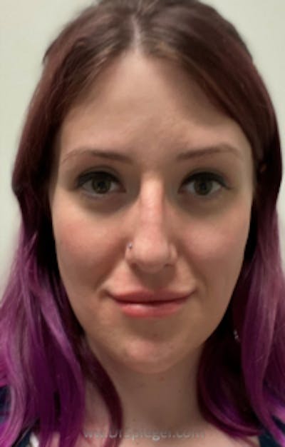 FFS Before & After Gallery - Patient 135296 - Image 2