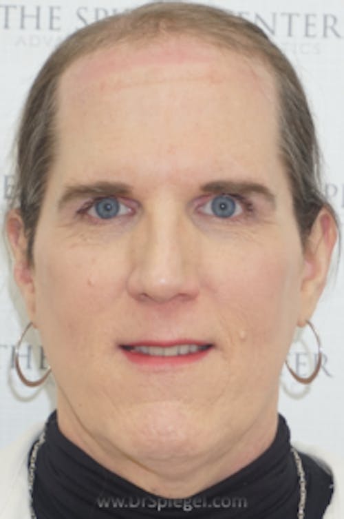 FFS Before & After Gallery - Patient 322148 - Image 1