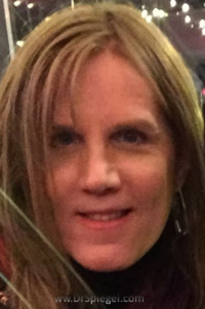 FFS Before & After Gallery - Patient 322148 - Image 2