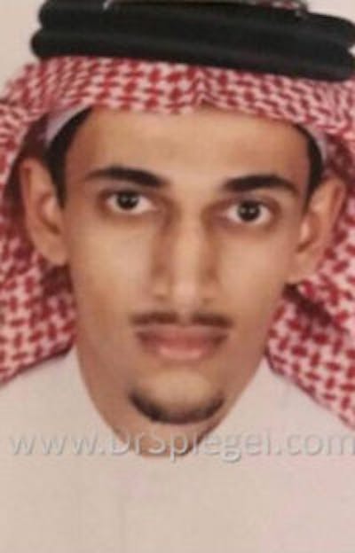 FFS Before & After Gallery - Patient 316018 - Image 1