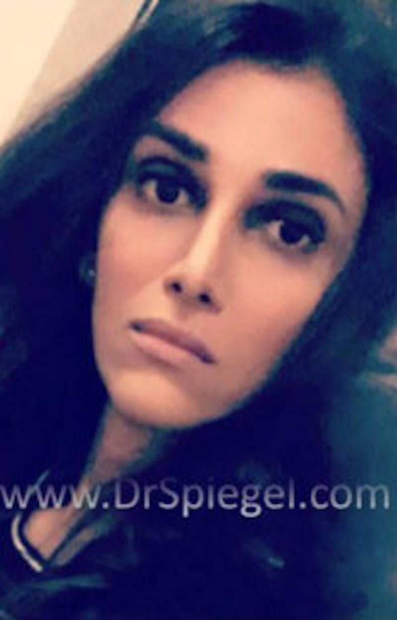 FFS Before & After Gallery - Patient 316018 - Image 2