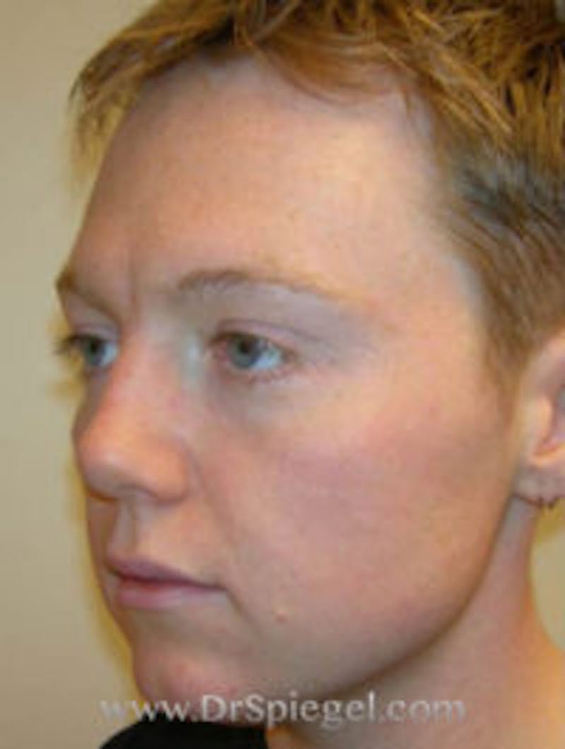 FFS Before & After Gallery - Patient 587047 - Image 1