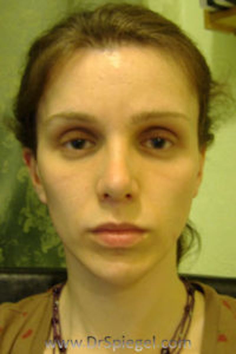 FFS Before & After Gallery - Patient 344693 - Image 2