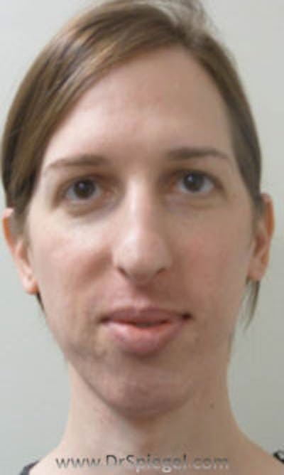 FFS Before & After Gallery - Patient 206626 - Image 1