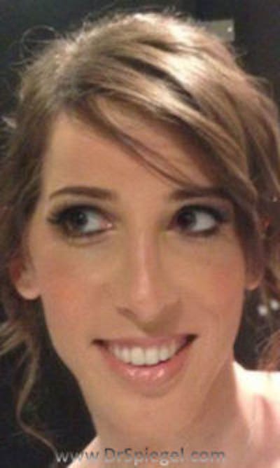 FFS Before & After Gallery - Patient 206626 - Image 2