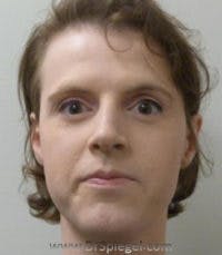FFS Before & After Gallery - Patient 578022 - Image 1