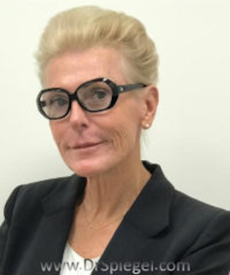 FFS Before & After Gallery - Patient 262300 - Image 2