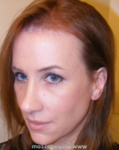 FFS Before & After Gallery - Patient 102303 - Image 2