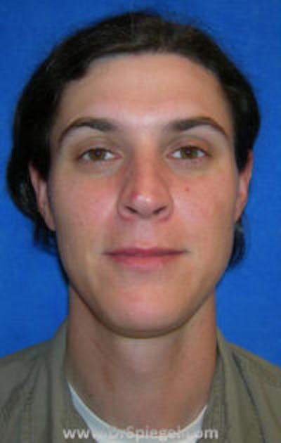 FFS Before & After Gallery - Patient 349857 - Image 1