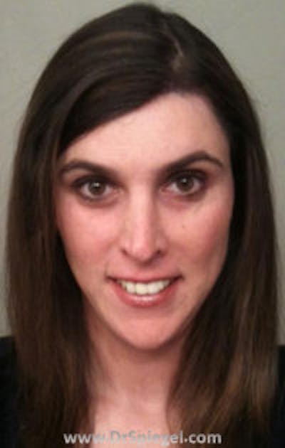 FFS Before & After Gallery - Patient 349857 - Image 2