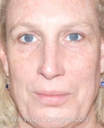 FFS Before & After Gallery - Patient 922421 - Image 1