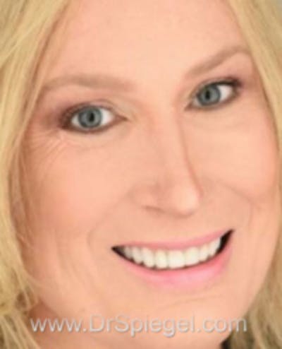 FFS Before & After Gallery - Patient 922421 - Image 2