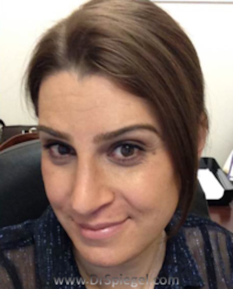 FFS Before & After Gallery - Patient 769278 - Image 2