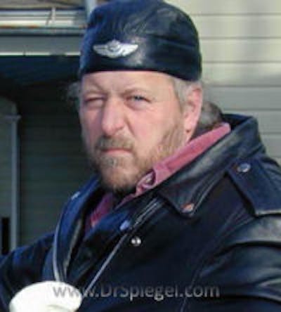 FFS Before & After Gallery - Patient 331630 - Image 1