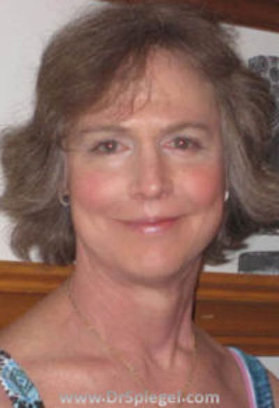 FFS Before & After Gallery - Patient 236569 - Image 2