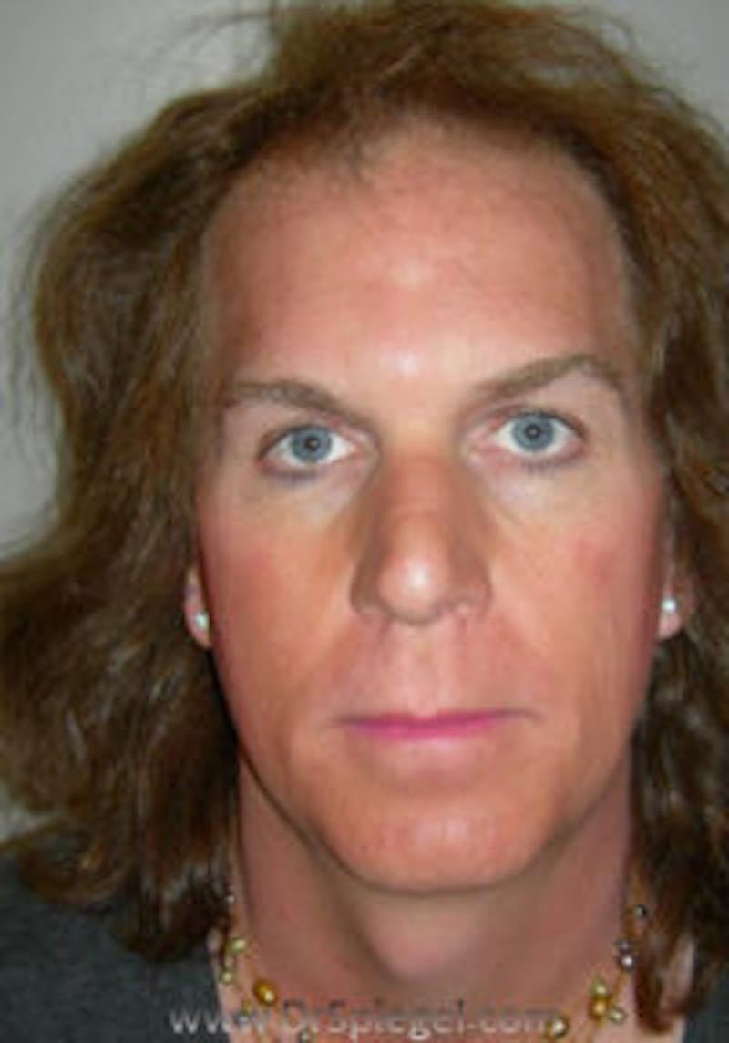 FFS Before & After Gallery - Patient 332739 - Image 1